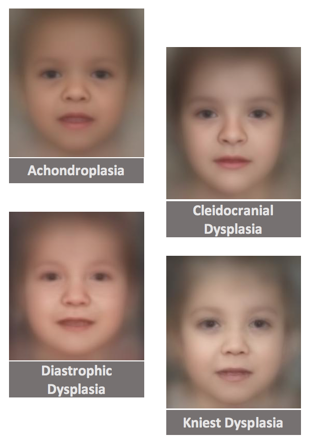 Skeletal Dysplasia