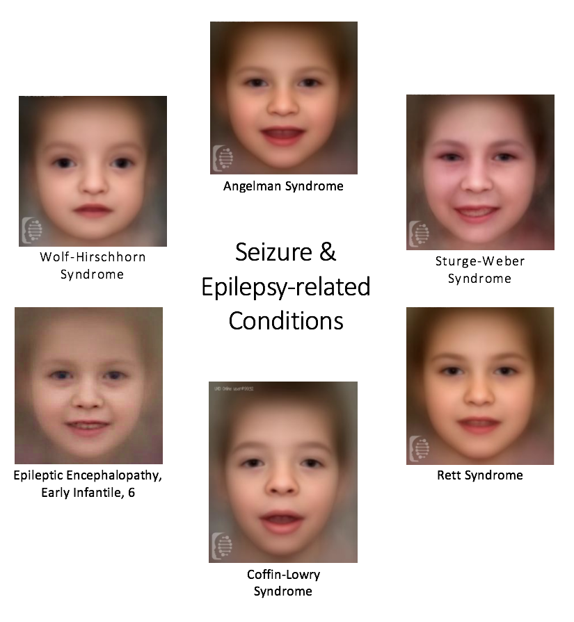 Seizure and Epilepsy