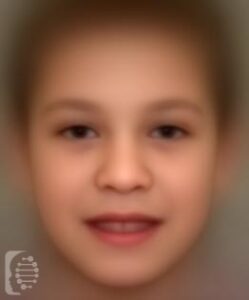 Fragile X Syndrome OMIM #300624