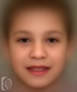 Fragile X Syndrome OMIM #300624