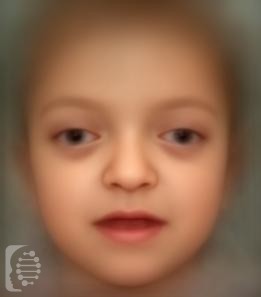 Crouzon Syndrome OMIM #123500