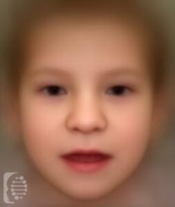 Koolen-de Vries Syndrome_ KDVS OMIM #610443