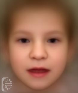 Koolen-de Vries Syndrome_ KDVS OMIM #610443