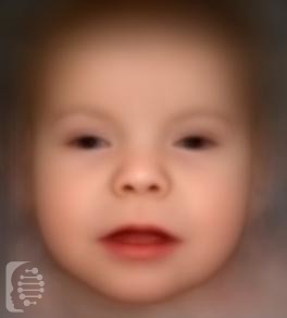 Pallister-Killian Syndrome_ PKS OMIM #601803