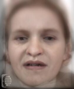 Basel-Vanagaite-Smirin-Yosef Syndrome