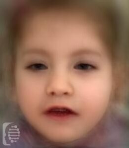 Birk-Barel Dysmorphism Syndrome