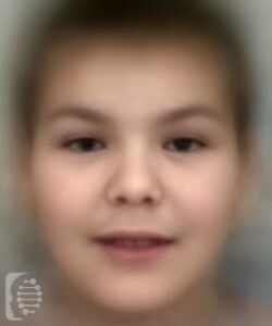 Borjeson-Forssman-Lehmann Syndrome