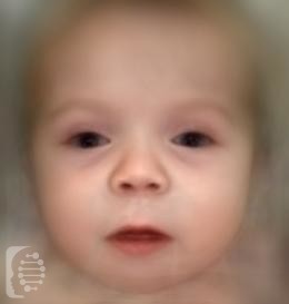 Campomelic Dysplasia