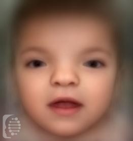 Craniofrontonasal Syndrome