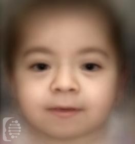 Hajdu-Cheney Syndrome