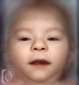 Chromosome 3pter-p25 Deletion syndrome