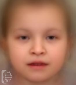 Chromosome 8q21.11 Deletion syndrome