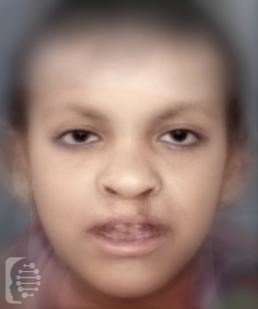 Clef Lip palate ectodermal Dysplasia