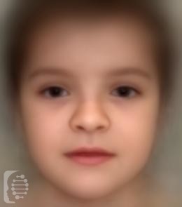 Cleidocranial Dysplasia