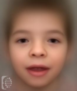 Coffin-Lowry syndrome