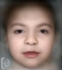 Craniofacial Dysmorphism, Skeletal Anomalies, and Mental Retardation syndrome