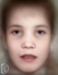 Craniometaphyseal Dysplasia