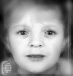 Craniosynostosis, Adelaide Type