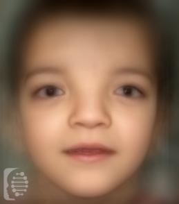 Donnai-Barrow syndrome