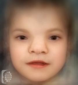 Frontonasal Dysplasia