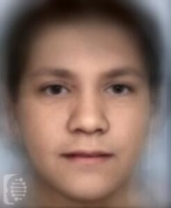 Hyper-IgE Recurrent Infection syndrome