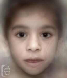 Lipodystrophy, Congenital Generalized