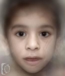 Lipodystrophy, Congenital Generalized